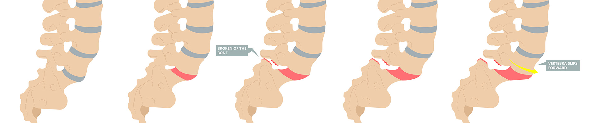 Σπονδυλολίσθηση