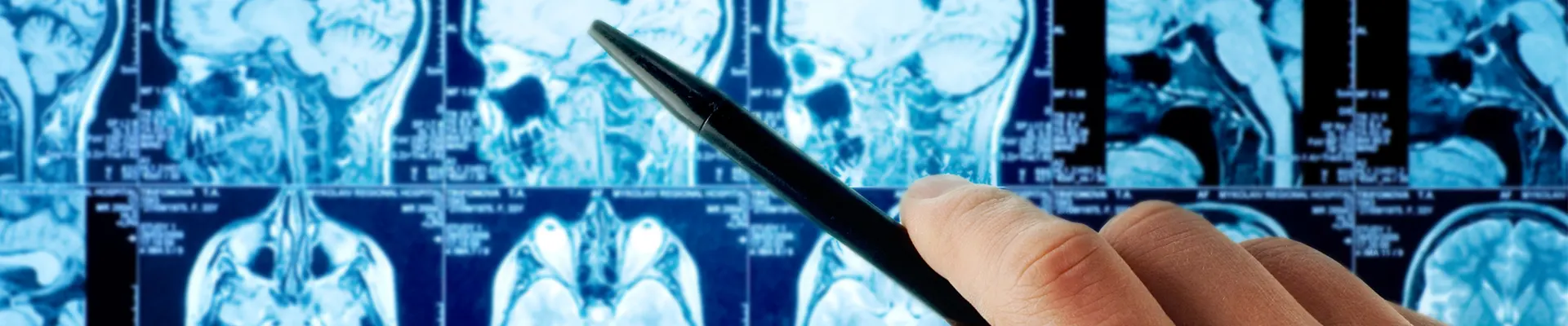 Μεταστατικοί Όγκοι Εγκεφάλου